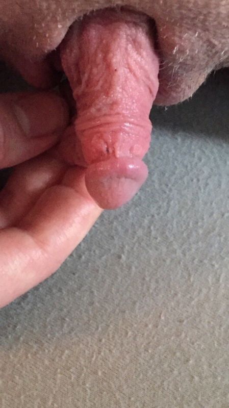 hermaphrodite clit penis