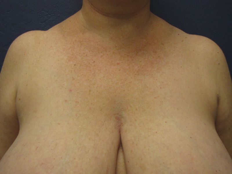 reduction mammaplasty