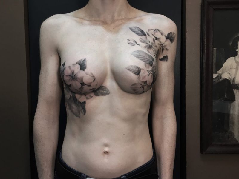 teenagers with double mastectomy