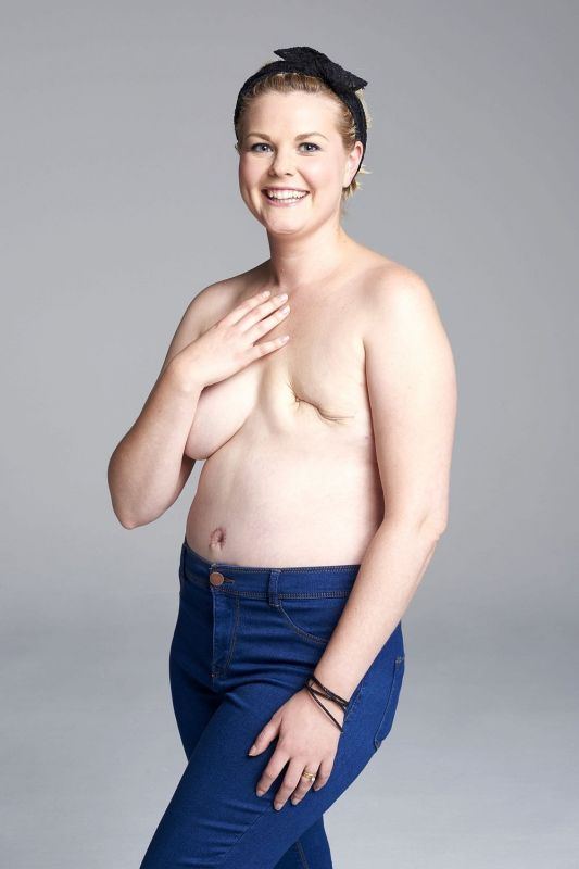 woman elective double mastectomy