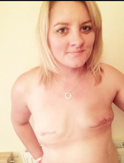 after double mastectomy expanders