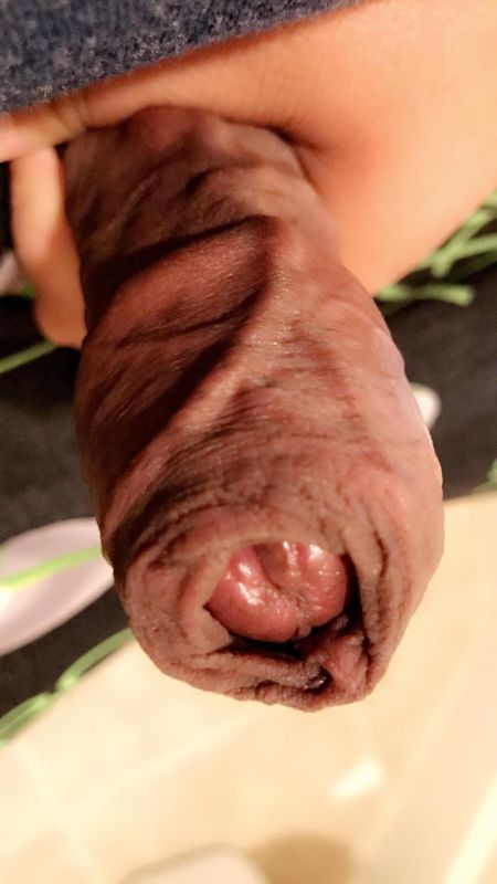 foreskin pictures