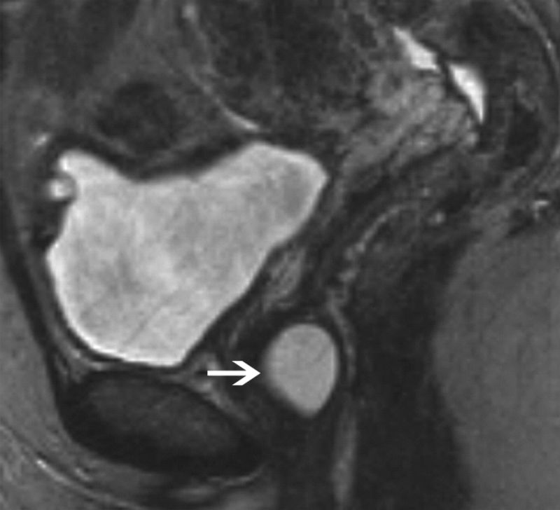 female genital atrophy