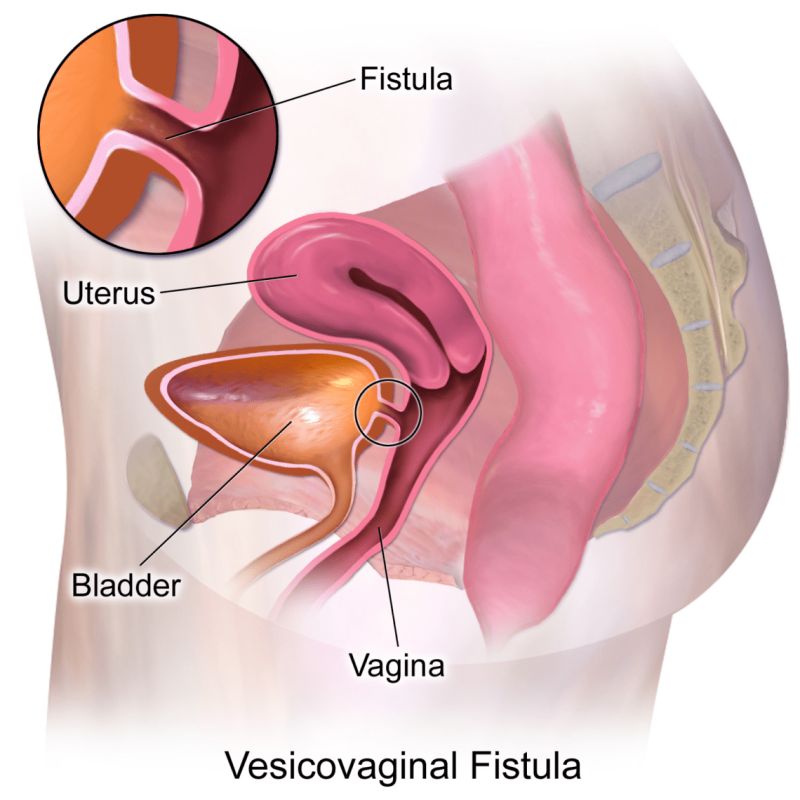 labial hypoplasia