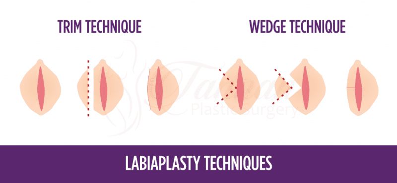 vagina/ labia
