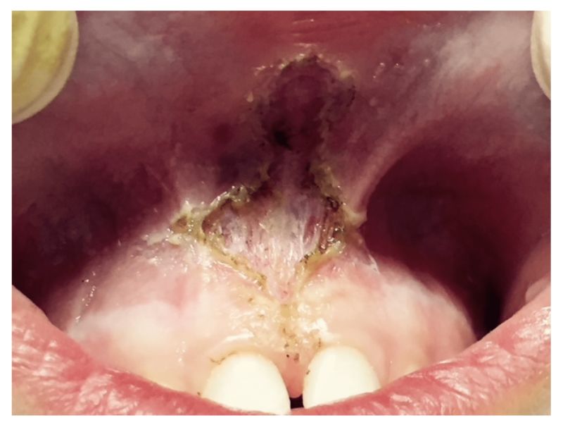 sublingual