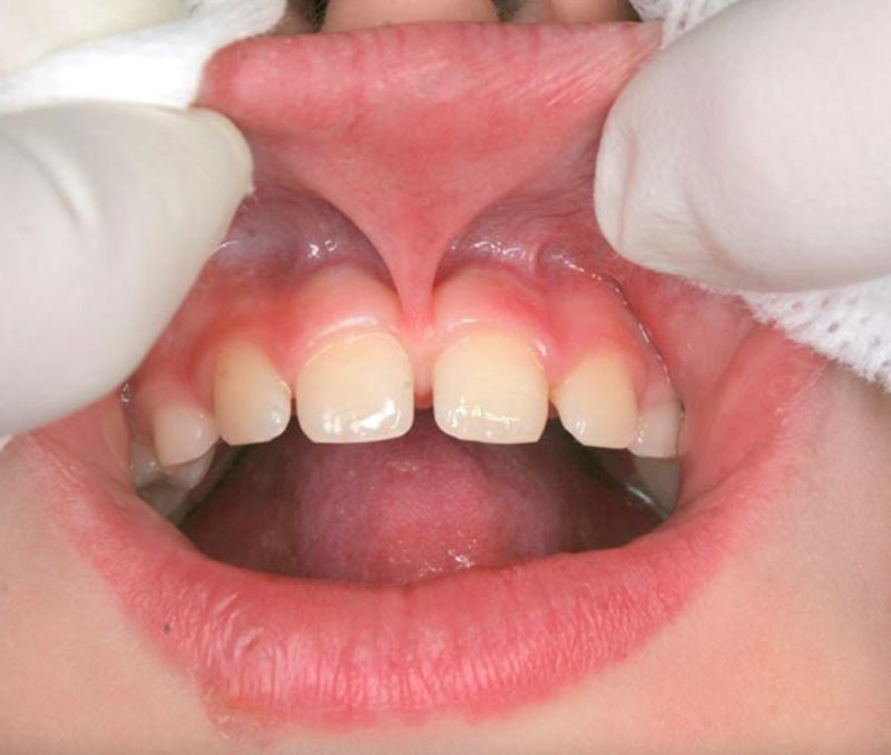 upper lip anatomy
