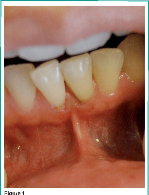 mass to superior labial frenulum