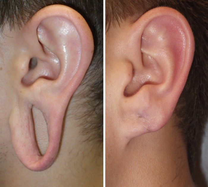 big ear holes