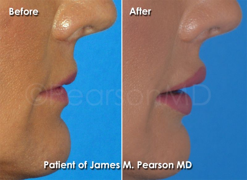 lip impant