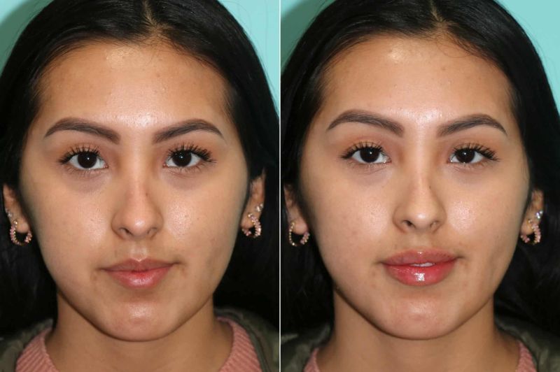 vs fillers