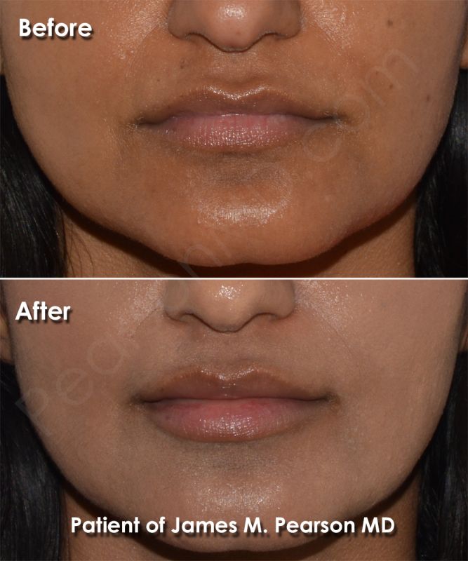 soft form lip implants