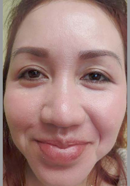 mild acne
