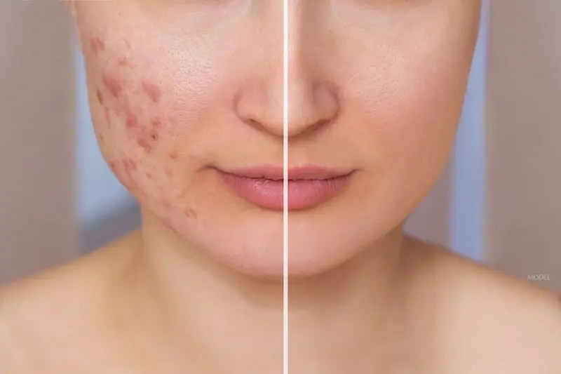 hereditary acne before and after