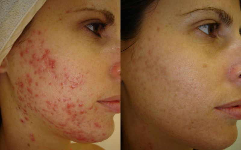 acne surgery procedure