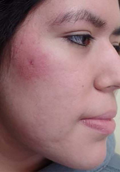 acne tablets