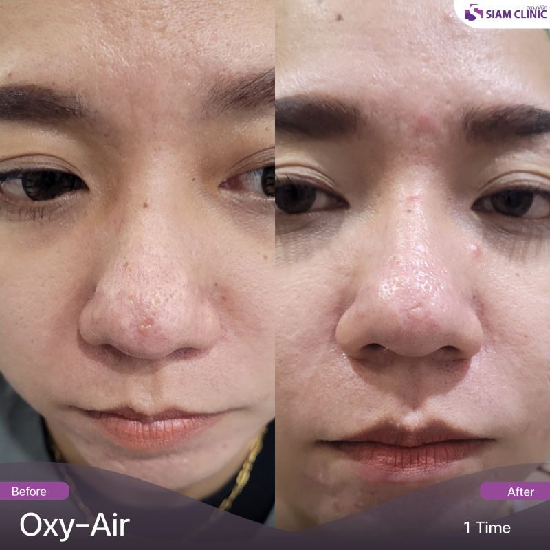 severe acne vulgaris