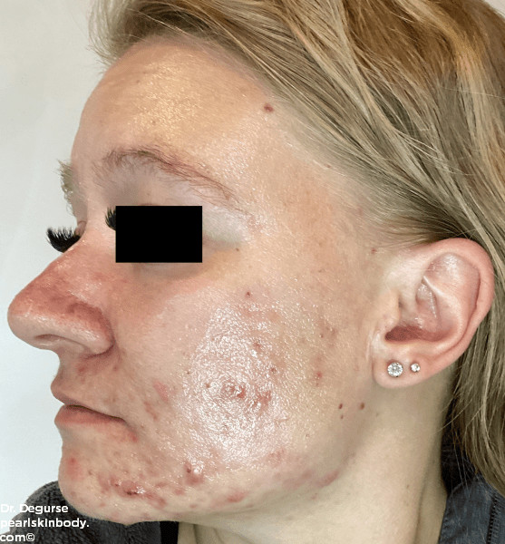 woman acne before and after