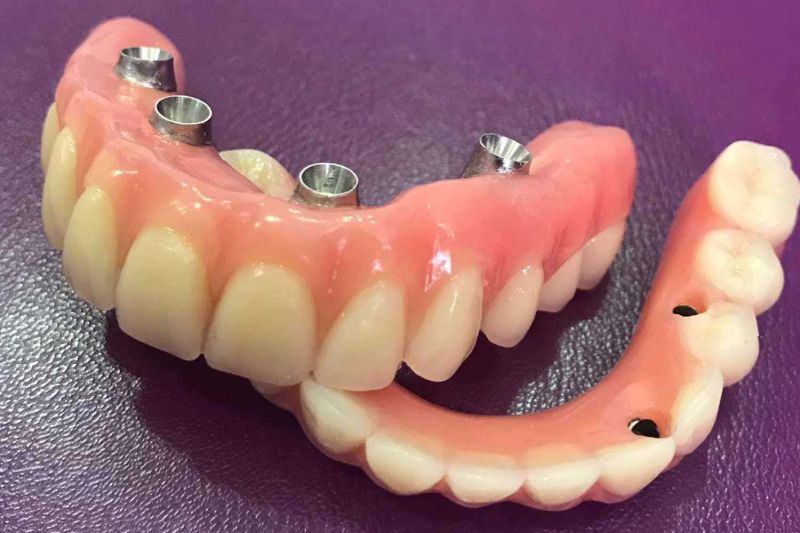upper jaw implants