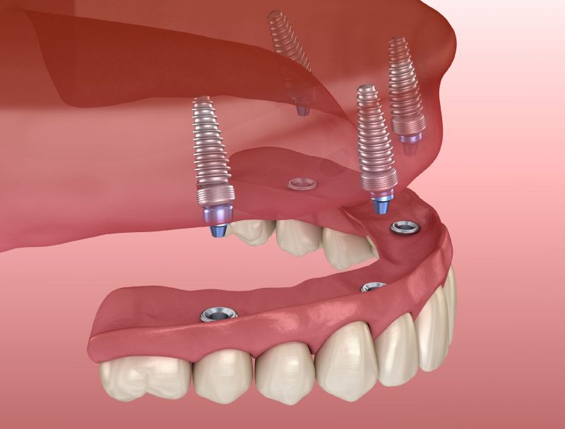 laser treatment