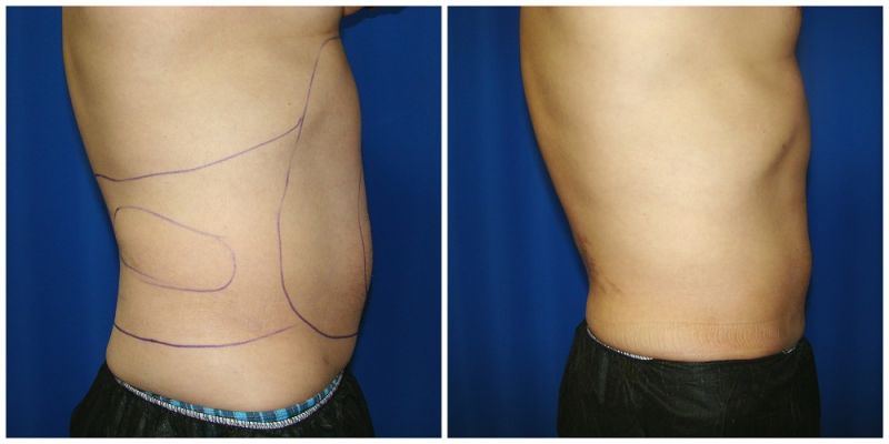 liposuction before and after lower back
