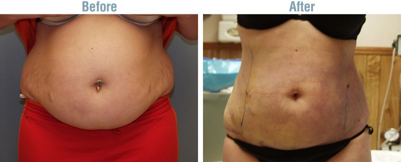 revision liposuction