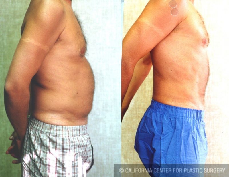 pictures of lumps after lipo