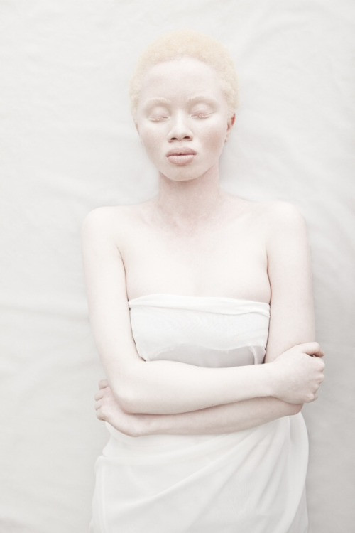 african albino twins