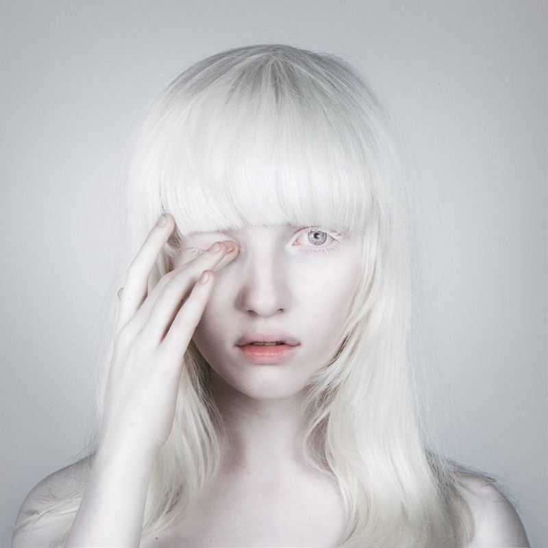 albino twins from brazil