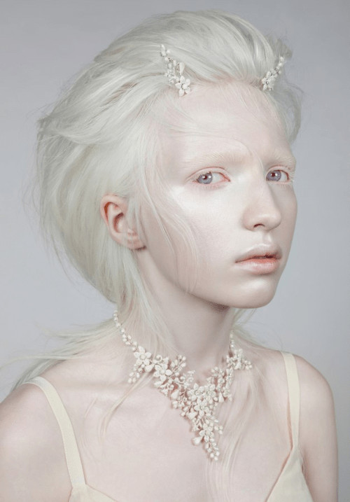 girl with albinism