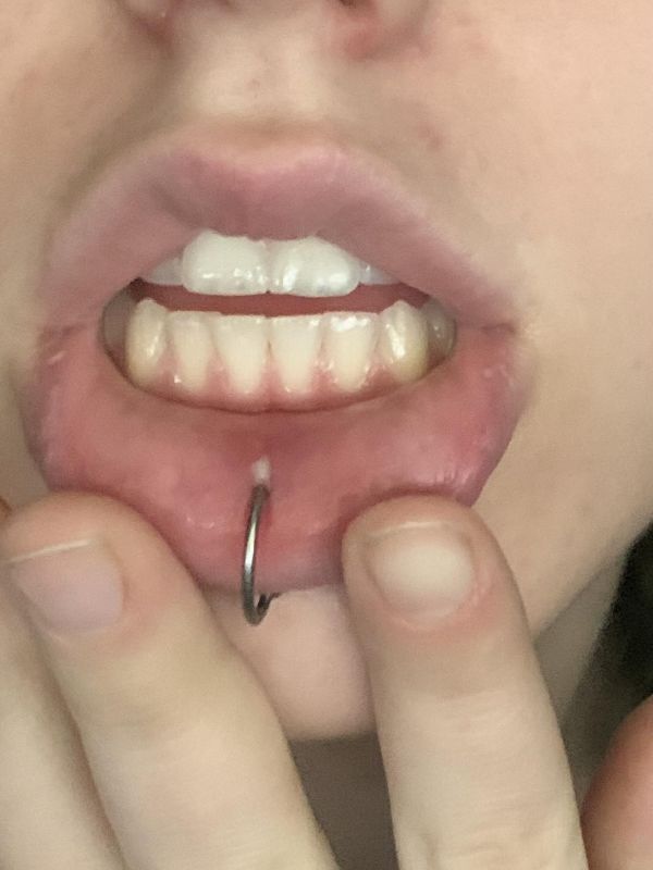 swelling