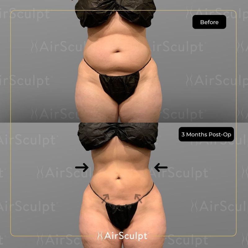 gut apron