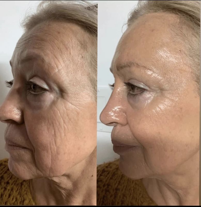 wrinkles around chin