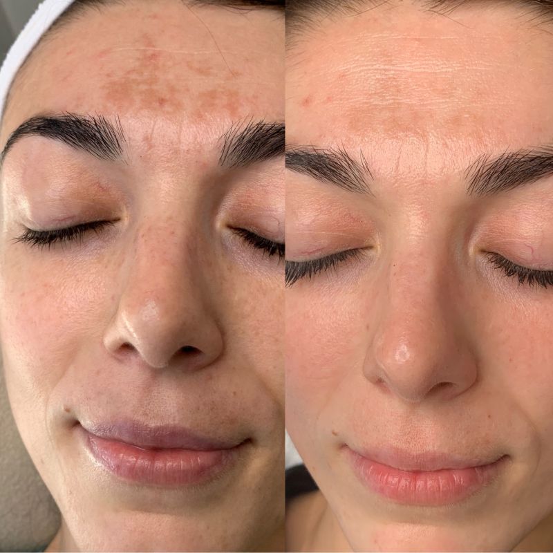 rhytidectomy before and after photos fake