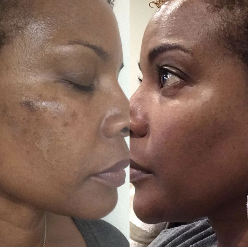 before and after facelift surgery