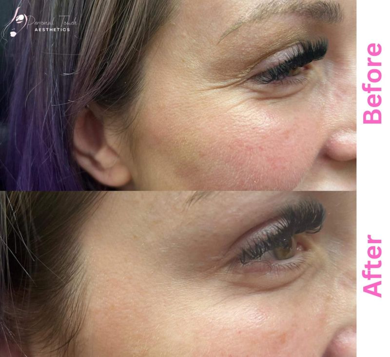 botox for men before and after