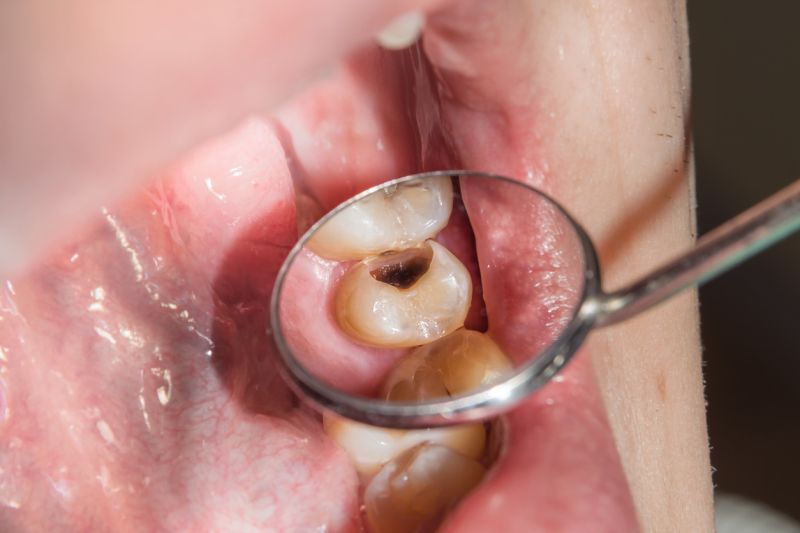 back tooth decay