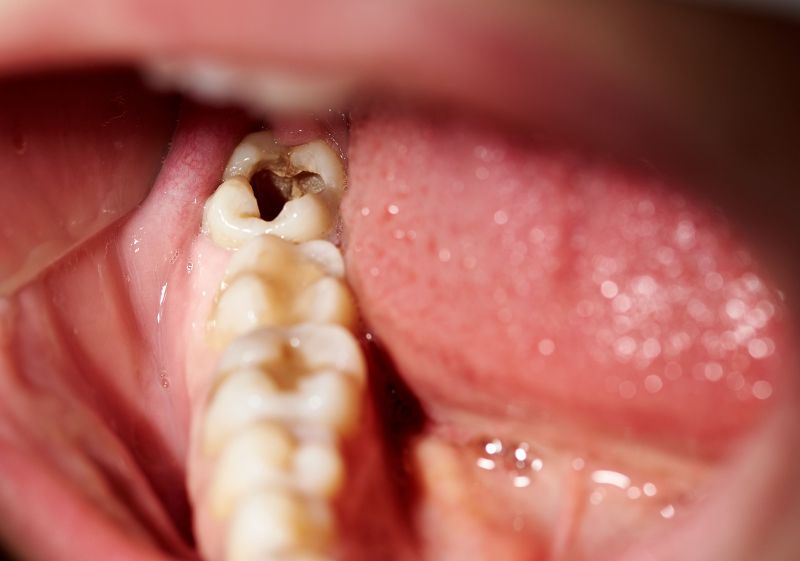 decaying teeth