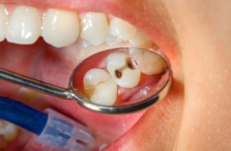 tooth cavity extraction