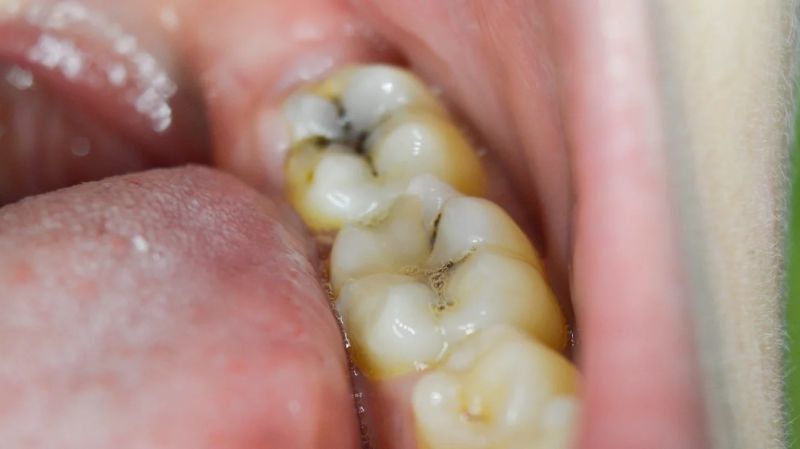 cavity on side of tooth