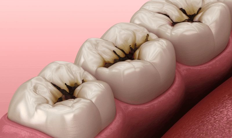 what does a tooth cavity look like
