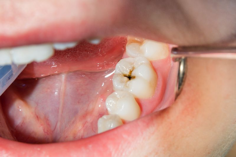 occlusal cavity