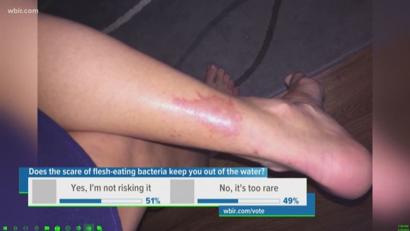bacterial skin infection