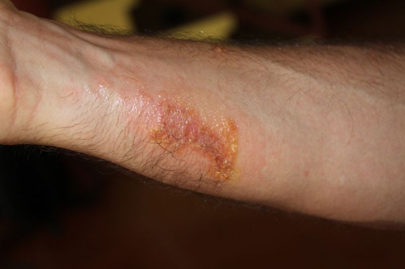 bacterial infection