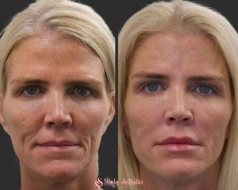 cosmetic filler injections