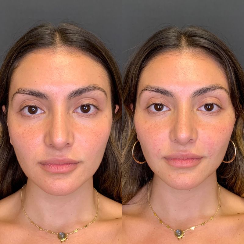 top lip filler before and after