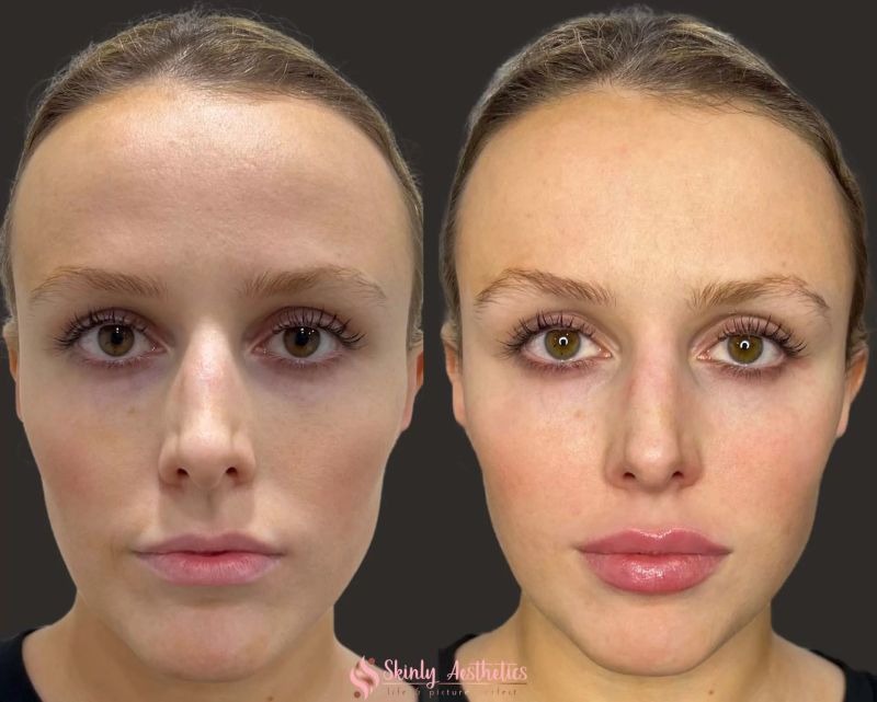 upper lip filler before and after