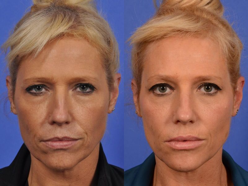 jaw filler before and after
