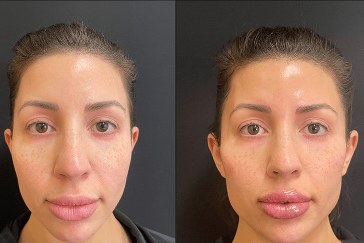 nasolabial filler before and after