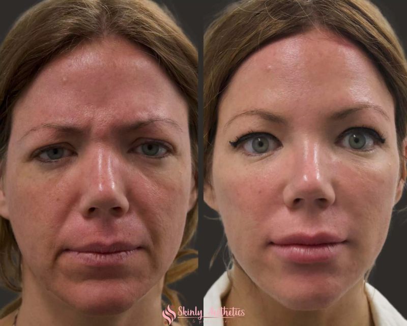chin filler before after